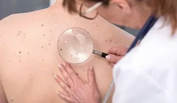 Descubren cómo funciona la primera línea de defensa contra el cáncer de piel