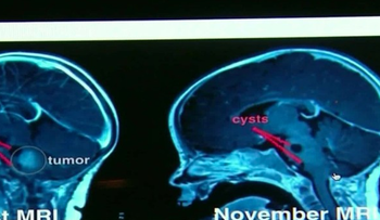 ¿Un beso del papá está ayudando a curar el cáncer de una bebé?