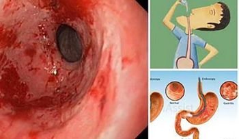 Cura la gastritis y la acidez de un TIRON con este eficaz remedio