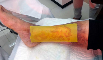Científicos crean un parche y logran cicatrizar pie diabético con miel de abeja