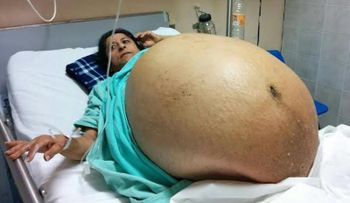 El antes y después de la mujer con tumor más grande del mundo