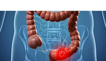 El cáncer colorrectal, una enfermedad que puede confundirse con colitis