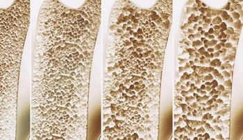 Crean medicamento que restaura huesos para combatir la osteoporosis