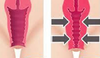 El remedio mejor que una cirugía para estrechar la vagina