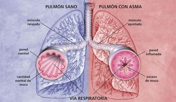 Para el asma, bronquitis, tos y enfermedades pulmonares