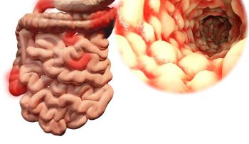 Nuevo tratamiento para enfermedad de Crohn está disponible en República Dominicana 