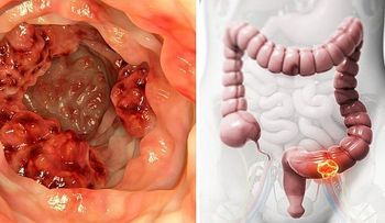 Demostrado científicamente: Este aceite destruye el 90% células cáncer de colon en 3 dí­as