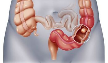 49 mil mueren al año por cáncer colorrectal en Latinoamérica 