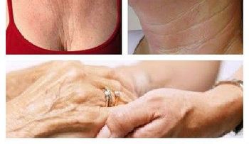 Tratamiento para prevenir arrugas en cuello y manos