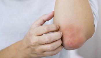 Enfermedades de piel conocida como psoriasis, provocan fuertes impactos emocionales