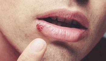 Alarma mundial: Un 67% población está contagiada de herpes