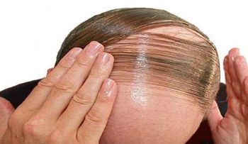¿Fin de la calvicie? Droga contra la artritis hace crecer el cabello