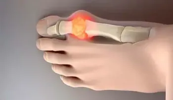 Elimina los cristales de ácido úrico de articulaciones con este simple remedio a base de pepino