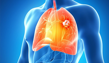 Te sorprenderá al ver que causa el cáncer de pulmón