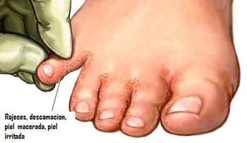 Tratamiento para hongos en las uñas o pie de atleta