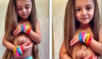Virsaviya, la niña que nació con el corazón por fuera del pecho