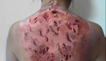 IMAGENES FUERTES: Enfermedades raras en el mundo 