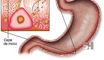 La bacteria Helicobacter pylori, tratamientos naturales.