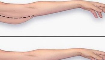 Entérate cómo eliminar la grasa del brazo sin recurrir a costosas cirugías