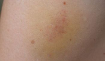 Si te salen moretones sin haberte golpeado, podrías tener alguna de estas enfermedades