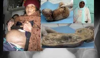 Hallan feto de 44 años en una mujer de 84