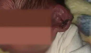 Médicos cortan oreja de recién nacido en una cesárea con la luz de tres celulares