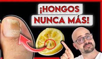 Remedios efectivos para hongos de los pies