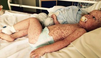 Este niño sufre del peor caso de varicela