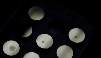 Primer caso de transmisión de enfermedad rara por donante