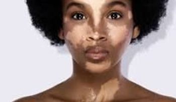 Vitiligo nunca MÁS. Nunca MÁS 