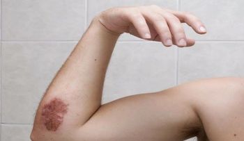 Razones "poco comunes" de por qué aparecen moretones en nuestra piel