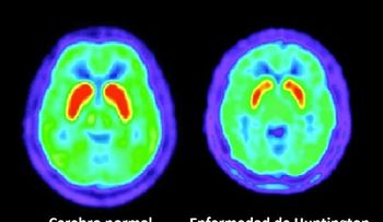 Hay dos formas de la enfermedad de Huntington; causas y tratamientos