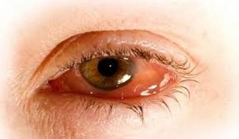 5 errores comunes que irritan los ojos
