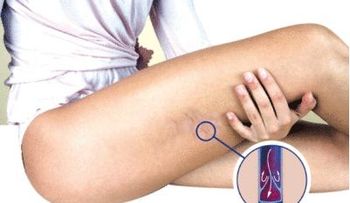 Simples trucos para combatir la mala circulación de las piernas 