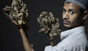 El hombre árbol supera con éxito primera operación