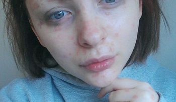 Un hombre abandonó a su novia que sufre de una rara enfermedad, cuando la vio sin maquillaje