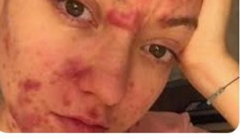 High sugar consumption causes acne