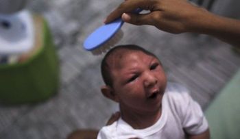 Dirección de epidemiología registra 28 casos de microcefalia asociados al virus del zika