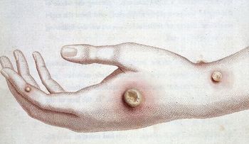 Un adolescente se infecta con un virus del siglo XVIII tras alimentar a varios terneros