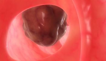El microbioma del cáncer de colon favorece la aparición de metástasis