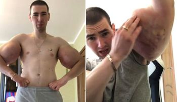 El drama del fisicoculturista "Popeye" que se inyectó aceite y ahora pide ayuda