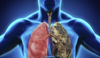 Un nuevo tratamiento aumenta la supervivencia en pacientes con cáncer de pulmón