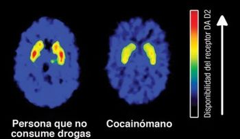 Los efectos en el cerebro del consumo de marihuana