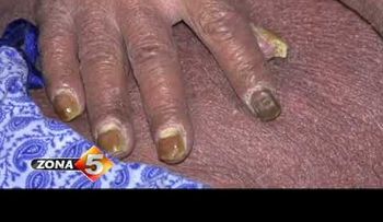 Atienden dominicano con piel de culebra; sufre de psoriasis