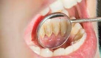 Te diremos un remedio para eliminar el sarro de tus dientes