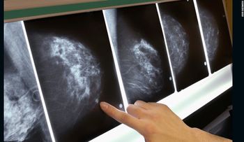 Hasta 270 mujeres pueden haber muerto por error en plan de detección de cáncer de mama en Inglaterra