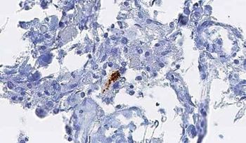 Demuestran que el alzhéimer se transmite entre humanos