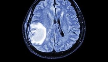 Descubren forma para atacar metástasis cerebrales