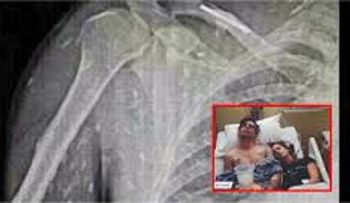 Este hombre terminó su cuerpo plagado de gusanos...por un descuido que pocos saben