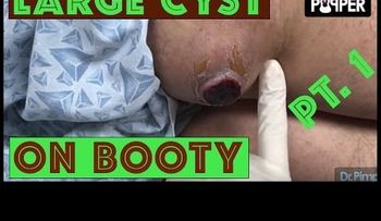 IMAGENES FUERTES: Doctor elimina un grano enorme de la espalda de un chico (VIDEO)